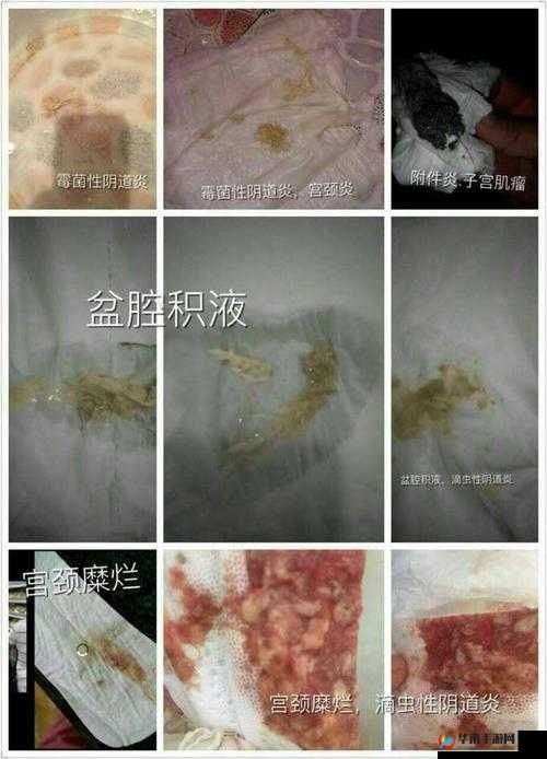 老中医李雪妮：排阴毒，你需要知道的