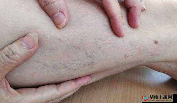 日系裸妆女士静脉曲张是什么得的：成因及预防