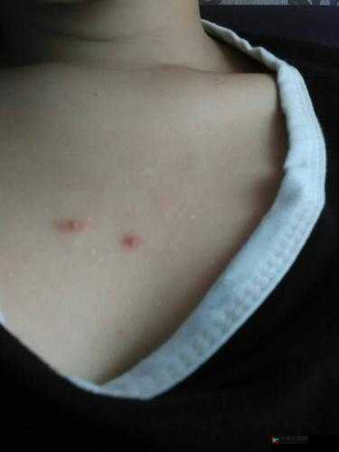 女生胸前长两个大疙瘩引关注